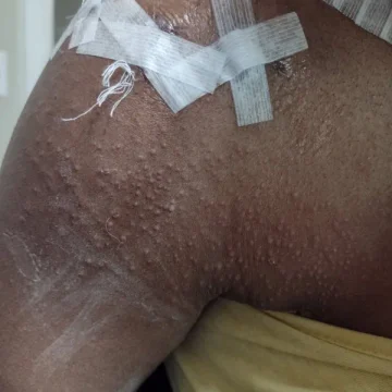 Medical tape over surgical incisions on a shoulder, with a bumpy skin rash spreading across the arm